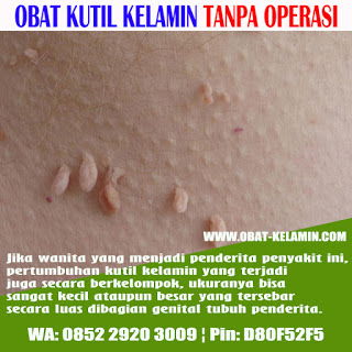 Berbagai Pilihan Obat Kutil Kelamin Terpercaya 