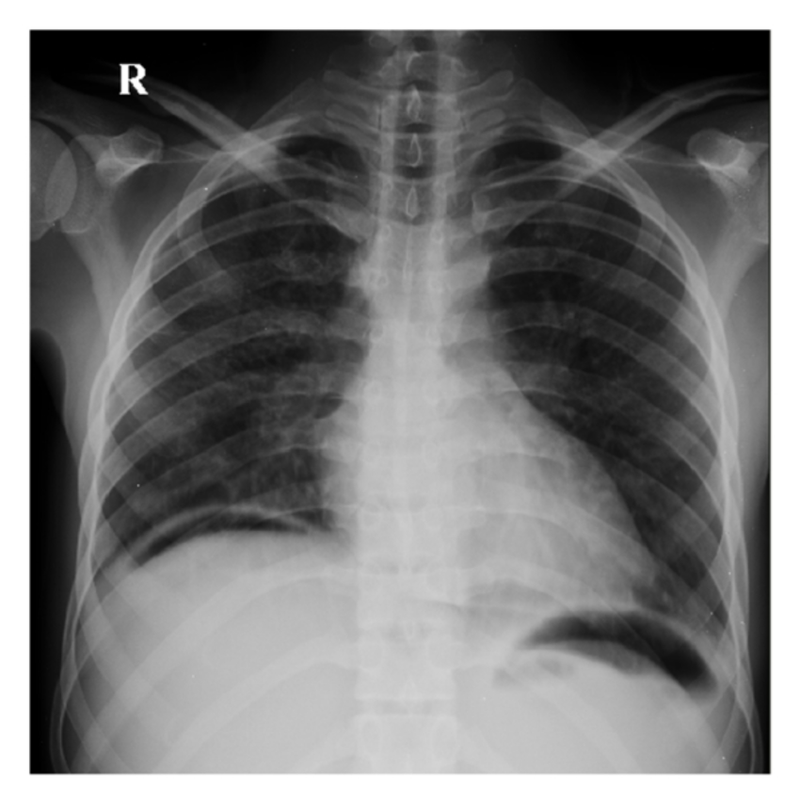 Air under the diaphragm - Surgery Family