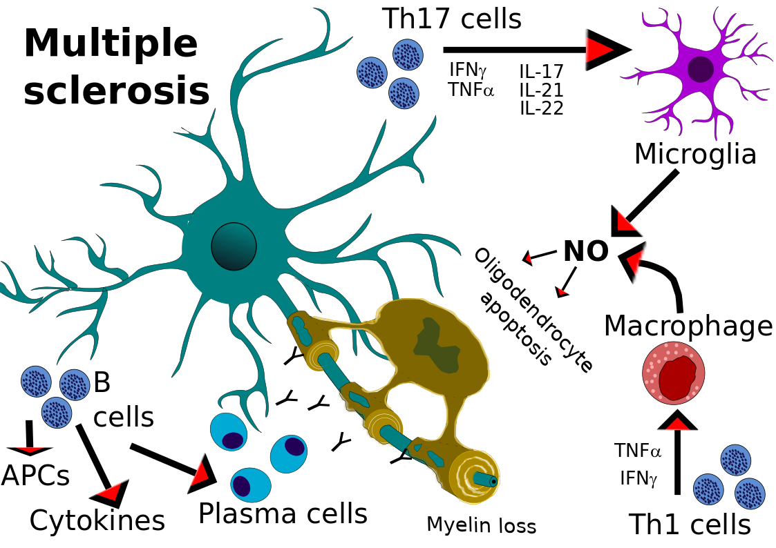 Overview Of Immunopathology In Multiple Sclerosis - SciMeditor