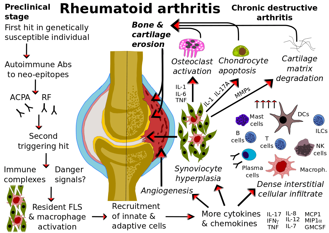 Overview Of Immunopathology In Rheumatoid Arthritis - SciMeditor