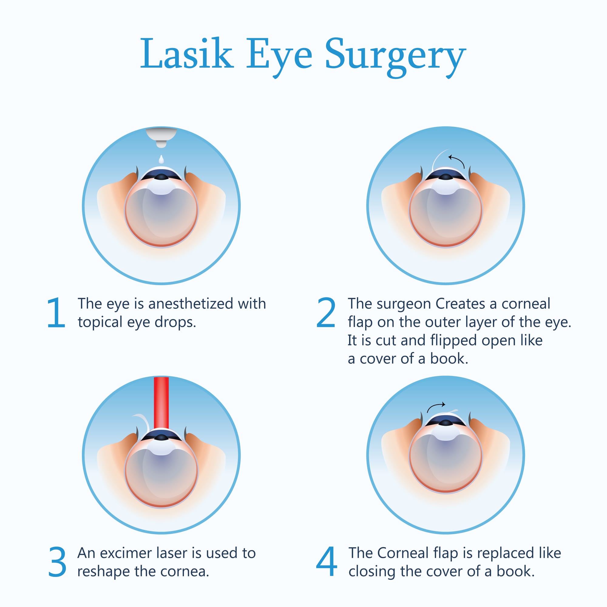 Escape Glasses Forever: Lasik Eye Surgery, Pleasanton