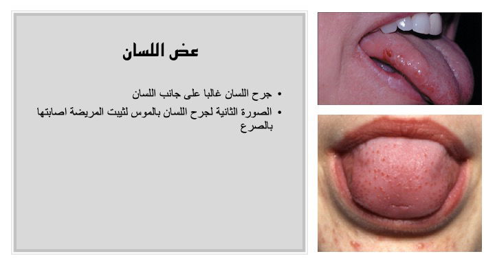 أمل جديد يبعد كابوس الموت المفاجئ عن مرضى الصرع Meo