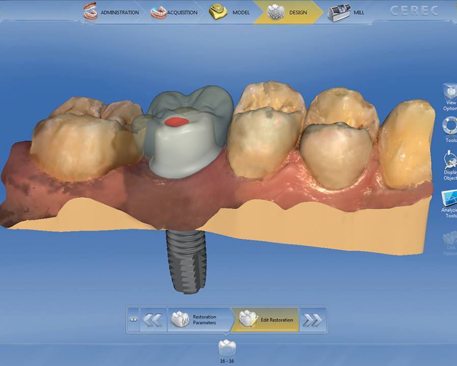 CAD/CAM Workflow for Implant using CEREC System - AIE | Implant ...